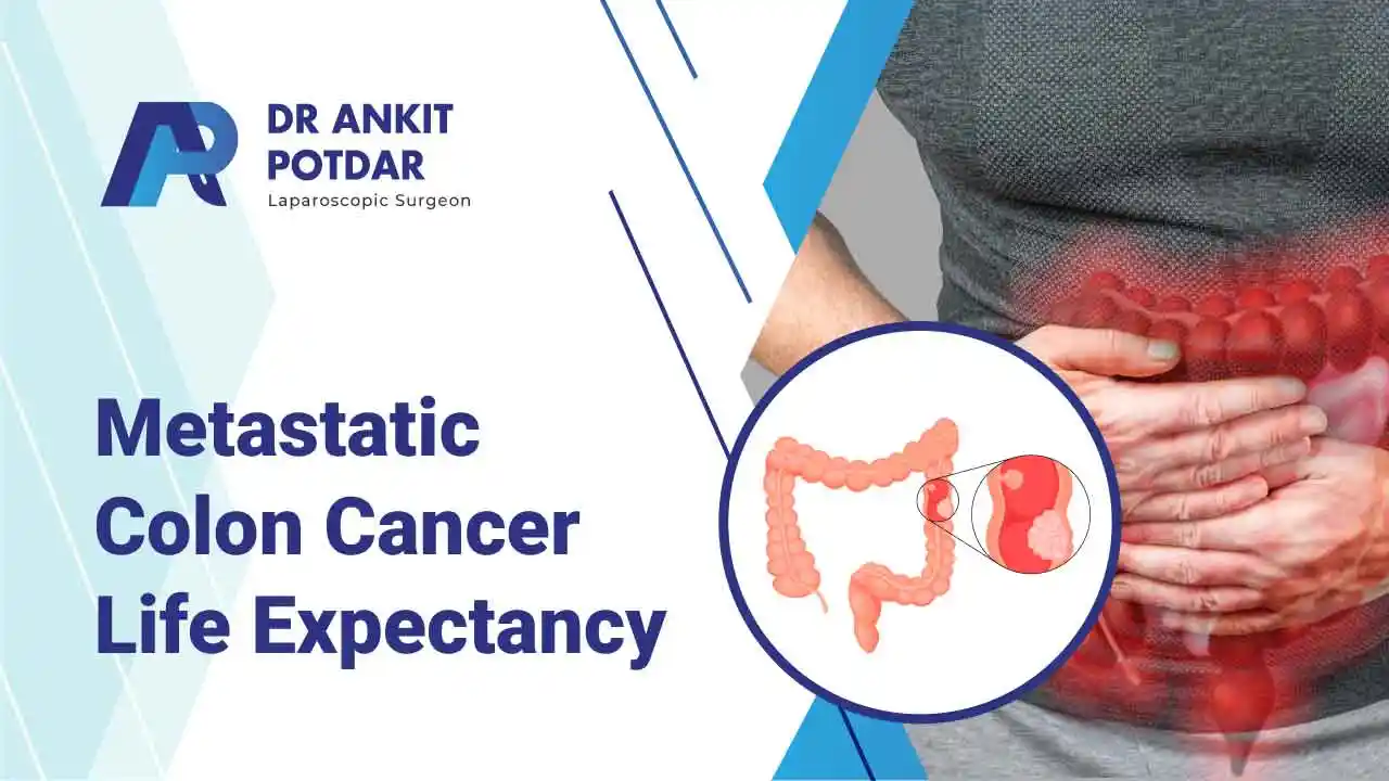Metastatic Colon Cancer Life Expectancy Prognosis and Treatment